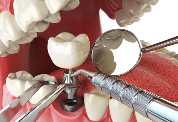 Nha khoa Emedic Dental là lựa chọn tốt nhất nếu bạn đang có nhu cầu trồng răng implant