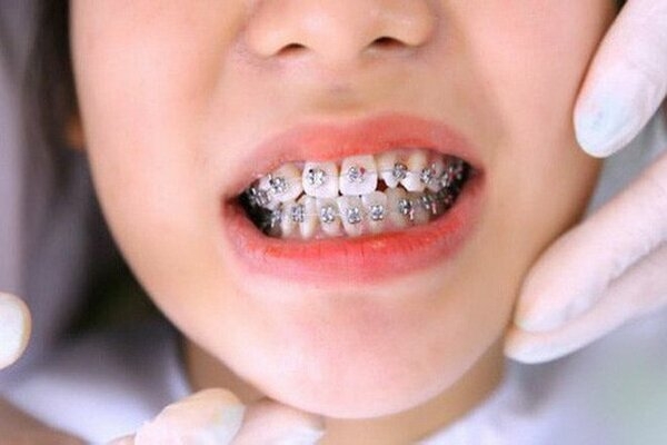 Quá trình điều trị niềng răng diễn ra như thế nào?