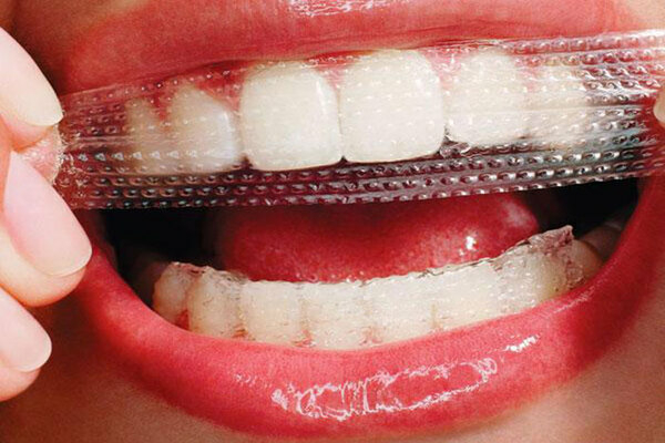 Miếng dán trắng răng là gì?