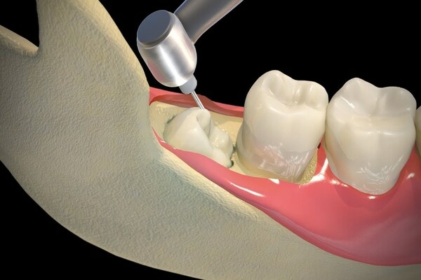 Răng khôn có nên nhổ không?