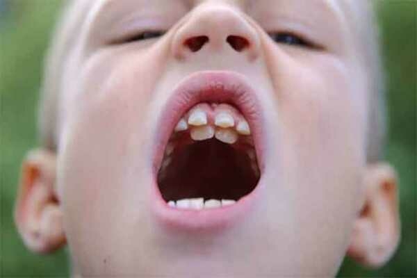 Hậu quả của răng mọc chồi là gì?