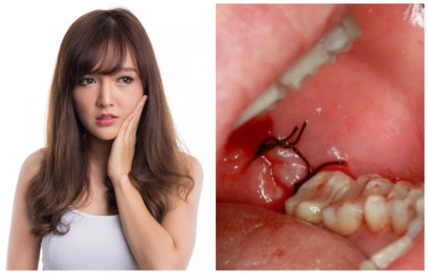 Nhiễm trùng sau nhổ răng là nguyên nhân phổ biến nhất gây ra màng trắng