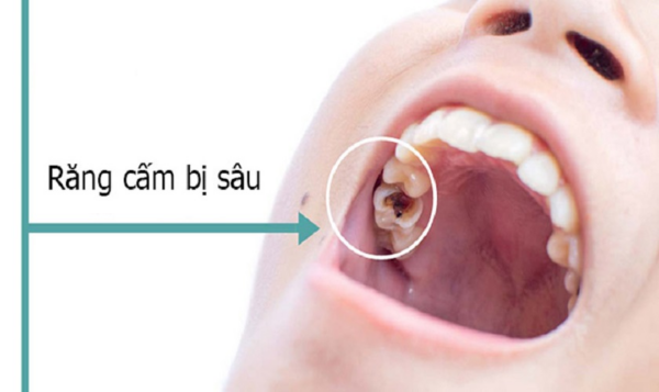 Đưa trẻ khám nha khoa định kỳ kiểm tra và phát hiện sớm nếu răng cấm có vấn đề để có phương án điều trị hiệu quả