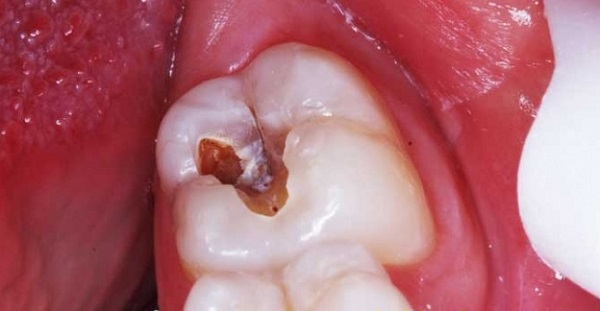 Tủy răng chết là tình trạng khiến nhiều người lo lắng bởi sự nguy hiểm tiềm ẩn của nó