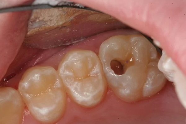 Sâu răng là nguyên nhân phổ biến nhất gây ra tình trạng răng chết tủy