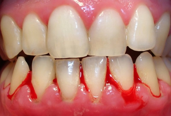 Viêm nướu không được điều trị sớm, tủy răng sẽ dần bị hoại tử và chết dần
