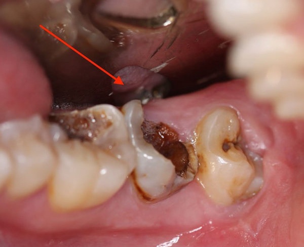 Răng chết tủy rất nguy hiểm nếu không được điều trị kịp thời