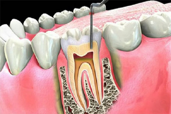 Trám tủy khi tủy còn sống, chưa hoại tử hoàn toàn, giúp bảo tồn răng