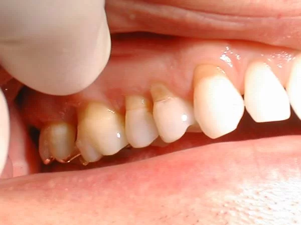 Hở chân răng là tình trạng thường gặp ở nhiều người, đặc biệt là người lớn tuổi