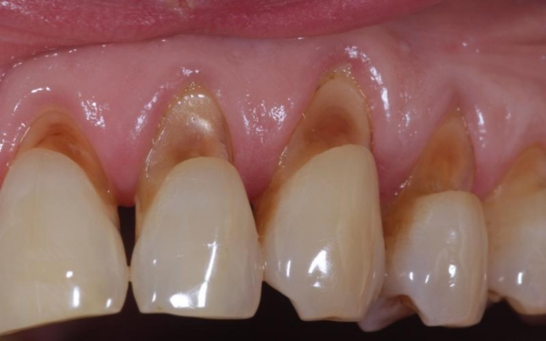 Có nhiều dấu hiệu nhận biết hở lợi chân răng