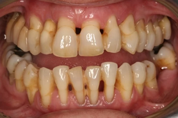 Do di truyền từ gia đình là một trong những nguyên nhân gây hở chân răng
