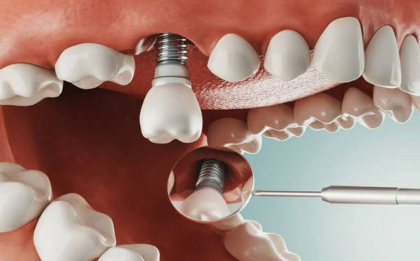 Trường hợp hở chân răng nặng thì phải nhổ bỏ răng và làm răng implant thẩm mỹ
