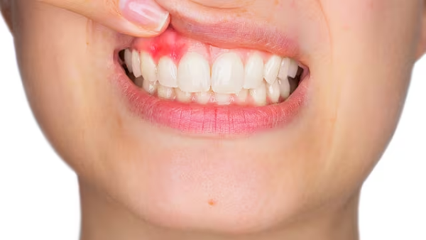 Sưng nướu răng là tình trạng nướu bị viêm đỏ, sưng tấy