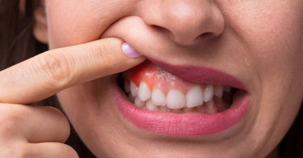 Bệnh viêm nướu là nguyên nhân phổ biến nhất gây sưng nướu răng