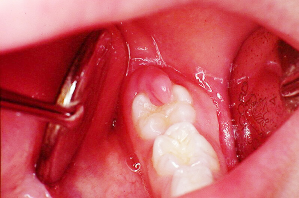 Sưng nướu răng do mọc răng khôn là một nguyên nhân sưng nướu răng