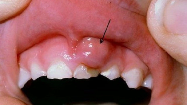 Sưng nướu răng và nổi hạch là bệnh gì?