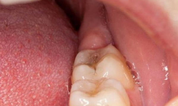 Răng khôn mọc gây áp lực lên nướu khiến bị viêm, sưng đỏ và đau nhức