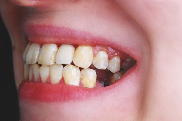 Sưng nướu răng nếu tình trạng kéo dài và không điều trị có thể làm mất răng