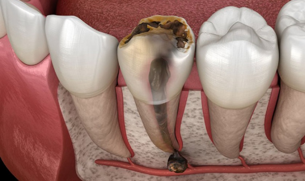 Có nhiều nguyên nhân chủ yếu dẫn đến tình trạng tủy răng bị tổn thương