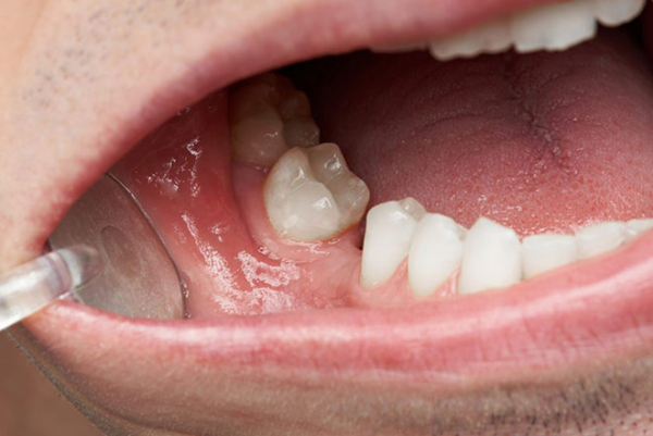 Mất răng và răng lỏng là dấu hiệu rõ ràng nhất của tình trạng tụt lợi