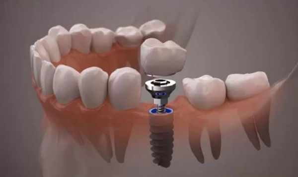 Phương pháp trồng răng implant giúp thay thế răng bị mất nếu tụt lợi do mất răng