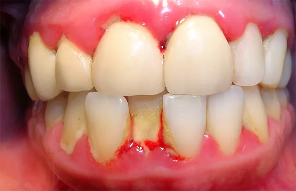 Viêm chân răng là tình trạng nhiễm trùng phổ biến