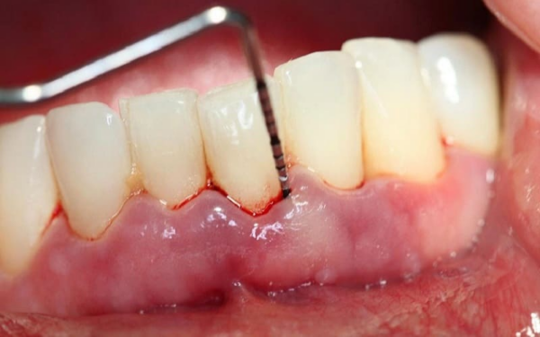 Có nhiều triệu chứng nhận biết viêm chân răng