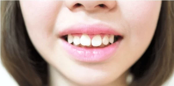 Răng vẩu là gì? Có nên điều trị răng vẩu không?