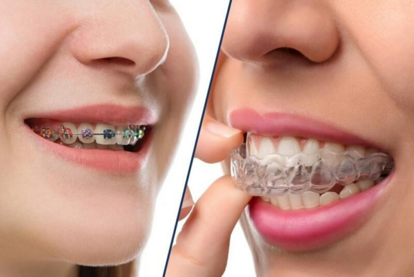 Niềng răng là phương pháp điều trị răng vẩu hiệu quả hiện nay và thẩm mỹ