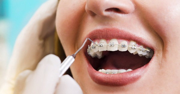 Tổng hợp các phương pháp nắn chỉnh răng hiệu quả