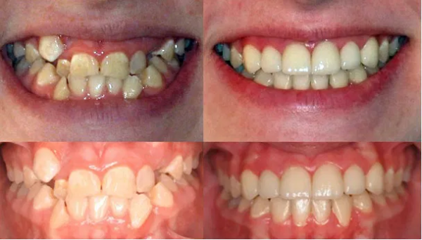 Trường hợp cần nắn chỉnh răng như răng không đều, hàm răng không khớp