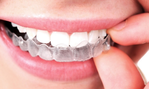 Niềng răng trong suốt là phương pháp nắn chỉnh răng phổ biến, ưa chuộng nhất hiện nay