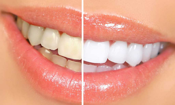 Có nên tẩy trắng răng không? Cách tẩy trắng răng hiệu quả