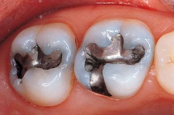 Amalgam là hợp kim của thủy ngân và các kim loại khác, là vật liệu trám răng truyền thống