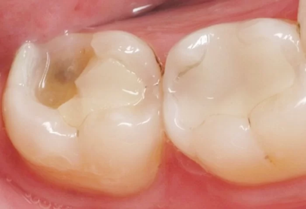 Trám răng không kín hoàn toàn là một trong những nguyên nhân sâu răng sau khi trám