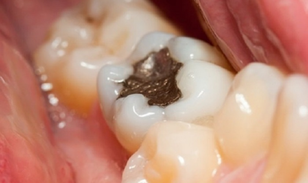 Chất lượng vật liệu trám kém nguyên nhân gây sâu răng sau khi trám