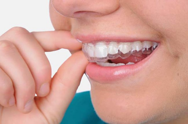 Niềng răng trong suốt là phương pháp khay niềng được thiết kế riêng cho từng trường hợp