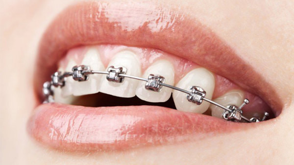 Niềng răng kim loại là phương pháp niềng răng truyền thống