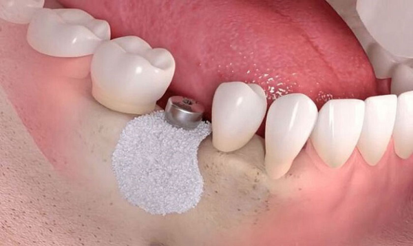 Trường hợp bị mất răng lâu năm cần ghép xương răng trước khi trồng răng implant