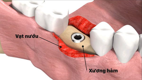 Tìm hiểu quy trình ghép xương răng cấy Implant