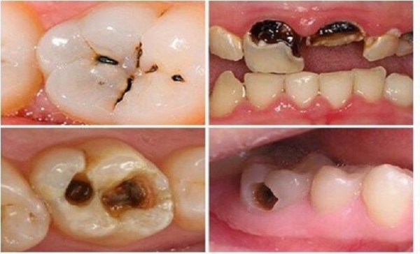 Sâu răng là một trong những nguyên nhân bị áp xe răng