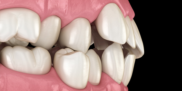 Nguyên nhân bị áp xe răng có thể do di truyền bị lệch khớp cắn, hàm dưới lệch lạc bẩm sinh