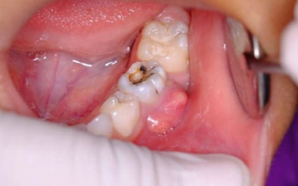 Nên đến nha khoa kiểm tra và điều trị áp xe răng hiệu quả