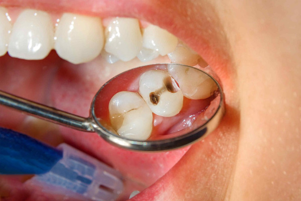 Những trường hợp nào cần lấy tủy răng?