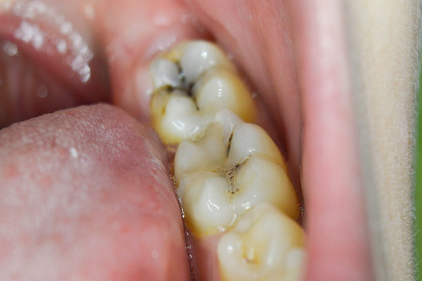 Sâu răng hàm có nên nhổ không?