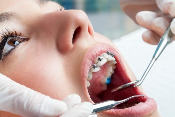 Trường hợp nào cần đặt thun tách kẽ răng?