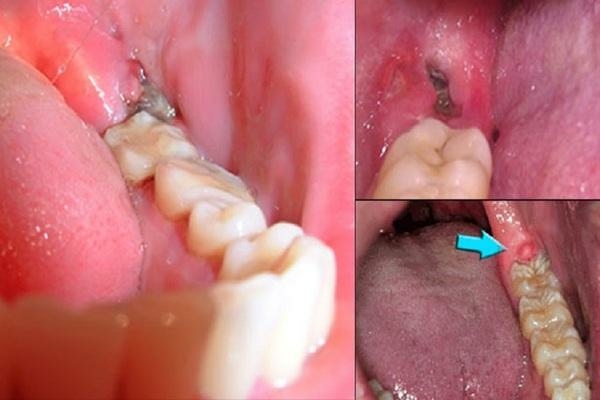 Nguyên nhân gây ra nhiễm trùng sau khi nhổ răng