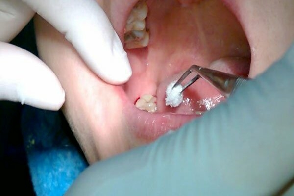 Các dấu hiệu nhiễm trùng sau khi nhổ răng và chẩn đoán nhiễm trùng