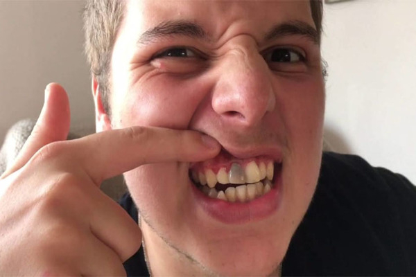 Nguyên nhân nào khiến răng cửa bị sâu?