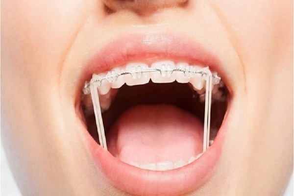 Siết răng khi niềng là gì?